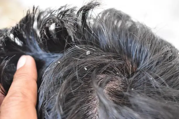 Men's hair is a top view close-up with Gray hair and Dandruff
