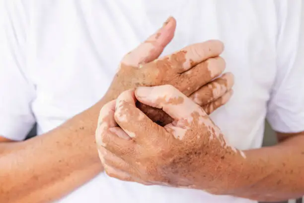 Photo of Close-up Vitiligo on skin hands of old people. medical condition causing depigmentation of patches of skin