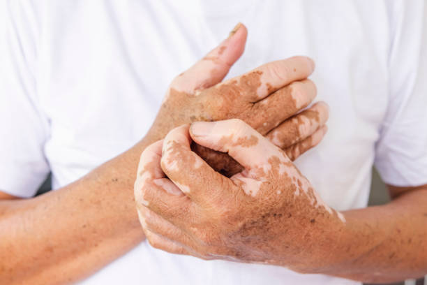 vitiligo de perto nas mãos da pele de pessoas idosas. condição médica causando despigmentação de manchas de pele - causing - fotografias e filmes do acervo