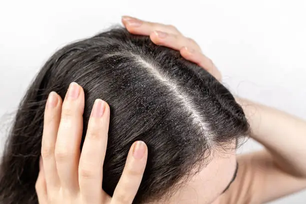 The woman holds her head with her hands, showing a parting of dark hair with dandruff. Close up. The view from the top. White background. The concept of dandruff and pediculosis.