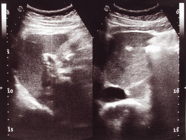 istock Diagnostic sonography of abdomen 1313458497