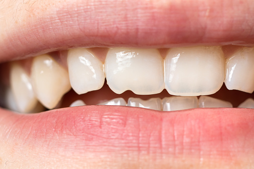 Macro primer plano de dientes humanos. Muestra el diente astillado. El efecto del diente del cortador de morder la cáscara de las semillas y los alimentos sólidos. photo