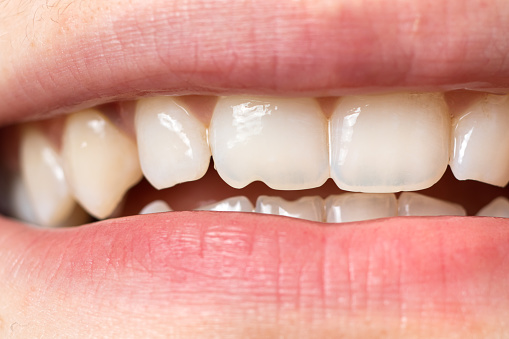 Macro close-up of human teeth. Shows the chipped tooth. The effect of the cutter's tooth from biting the seeds shell and solid food.