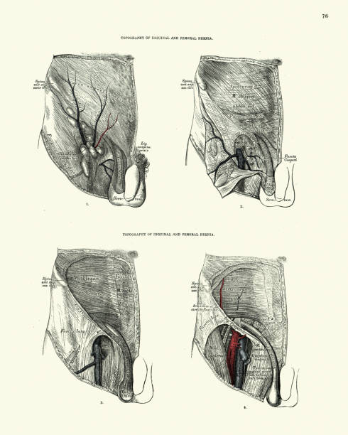 Anatomy, Topography of inguinal and femoral hernia, Victorian anatomical drawing 19th Century Vintage illustration of Anatomy, Topography of inguinal and femoral hernia, Victorian anatomical drawing 19th Century femur bone anatomy drawing stock illustrations