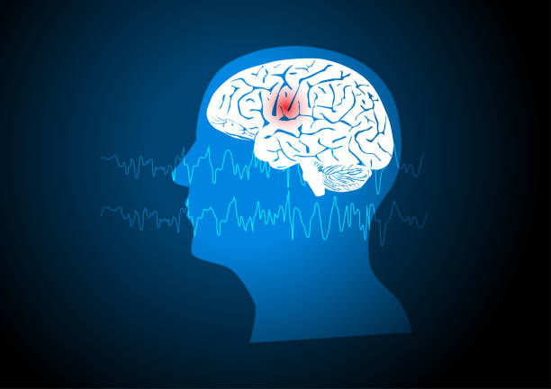 Concepts of human focal seizure or epilepsy Focal seizure. Illustration of human brain and electroencephalograhy or EEG originating from one regional onset. epilepsy stock illustrations