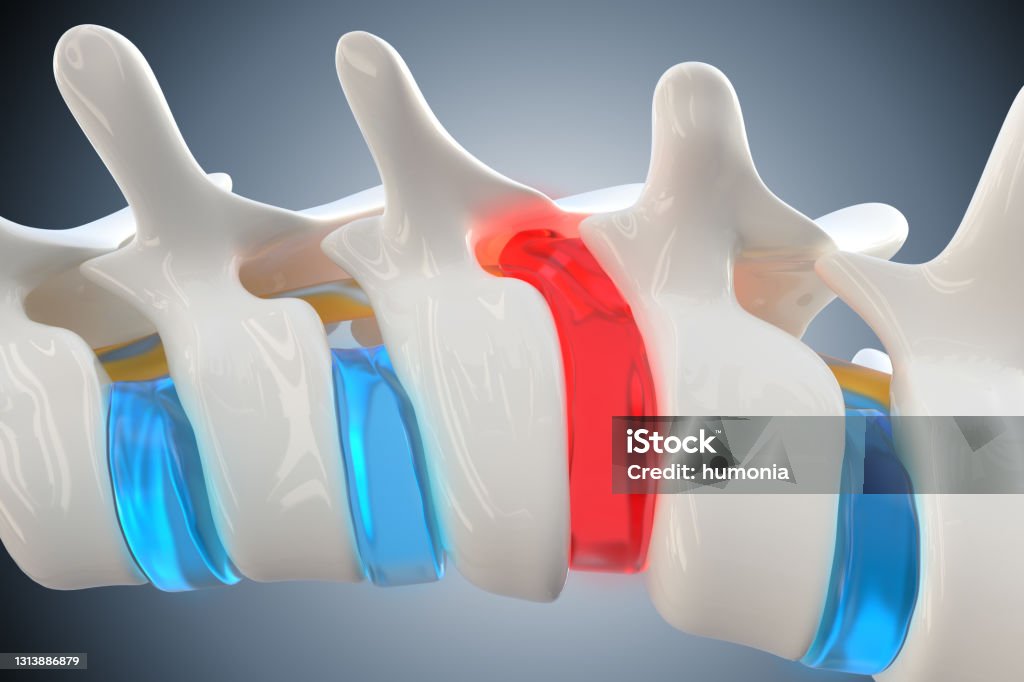 Herniated disk compresses the spinal cord Herniated, prolapsed disk compresses the spinal cord causing back pain and other health problems, 3d illustration Herniated Disc Stock Photo