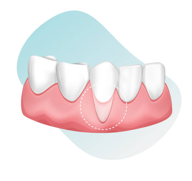 ilustrações de stock, clip art, desenhos animados e ícones de dental checkup for receding gums - stock illustration - gums
