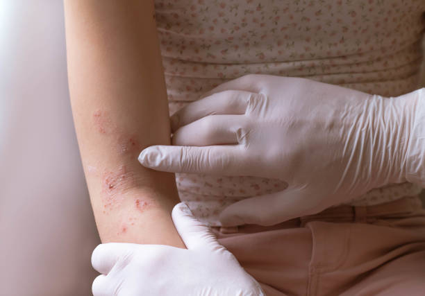 mains du docteur examinant l’eczéma - eczema photos et images de collection