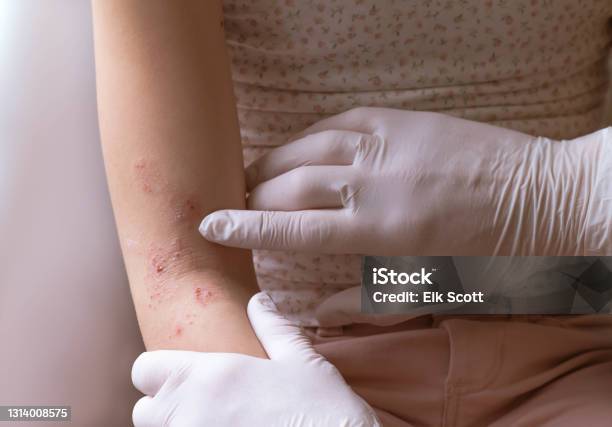 Doctors Hands Examining Eczema Stock Photo - Download Image Now - Eczema, Atopic Eczema, Child