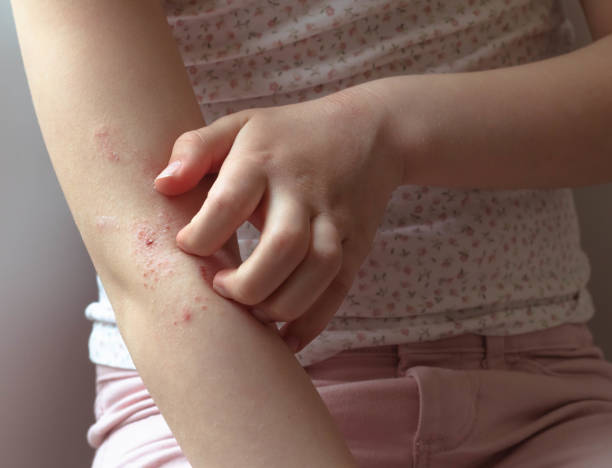 A child scratching an eczema Eczema on right arm, left hand scratching the skin. Girl is wearing a white sleeveless top with flowers and pink pants. dermatitis photos stock pictures, royalty-free photos & images