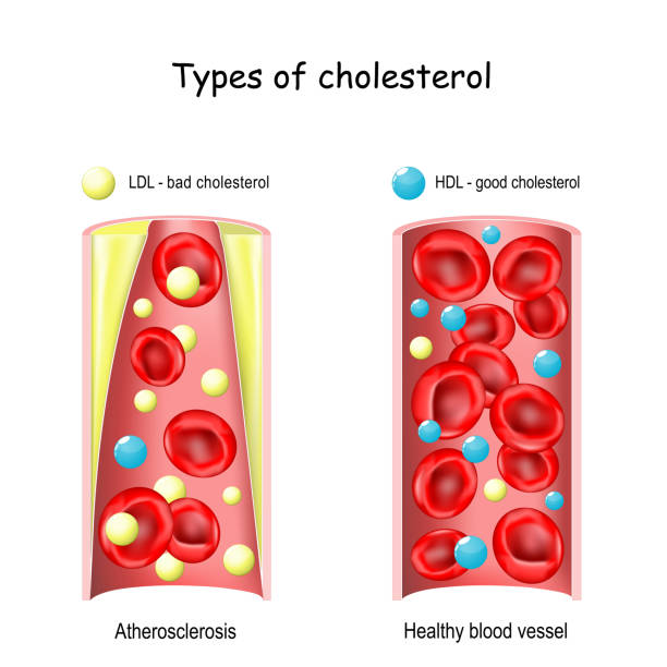 illustrazioni stock, clip art, cartoni animati e icone di tendenza di colesterolo. lipoproteina hdl e ldl. - cholesterol