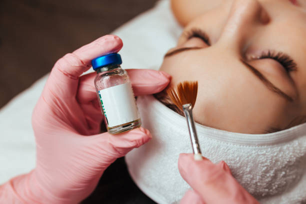 Chemical Peel Process