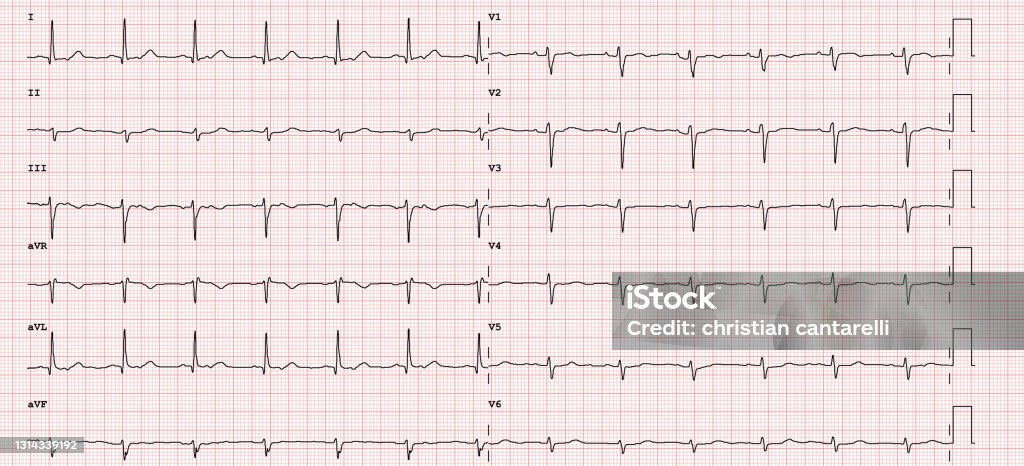 Normal Ecg Examples Ecg Example Of A Normal 12lead Sinus Rhythm Stock Illustration ...