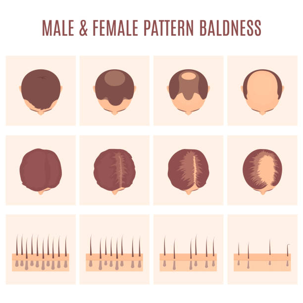Big set of baldness classification in men and women Male and female-pattern hair loss set. Stages of baldness in men and women. Head in top view. Number of follicles on scalp in each step. Alopecia infographic medical vector illustration. hair loss stock illustrations
