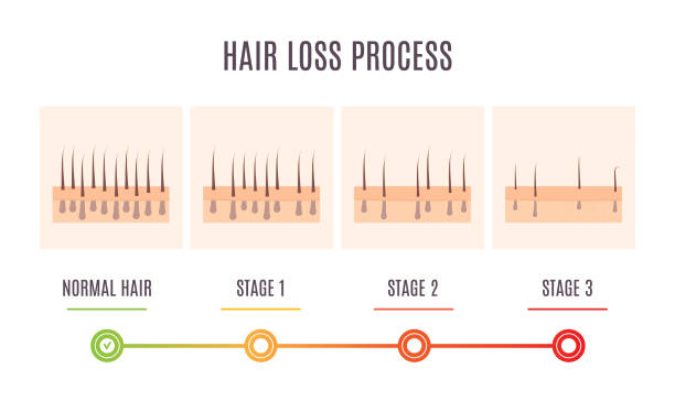 ilustrações, clipart, desenhos animados e ícones de diagrama de seção transversal da pele do couro cabeludo mostrando processo de queda de cabelo - alopecia antes depois
