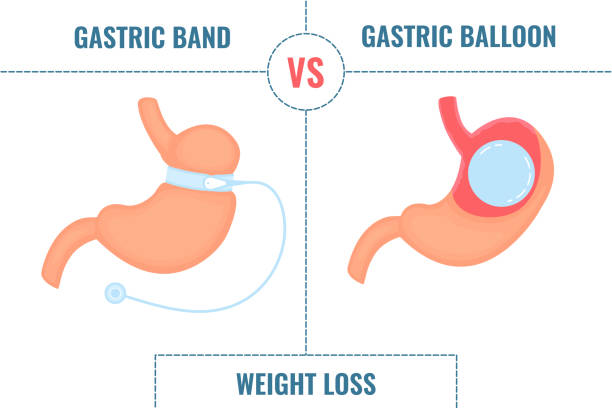 illustrations, cliparts, dessins animés et icônes de bande gastrique vs ballon gastrique infographies de perte de poids de chirurgie - human large intestine