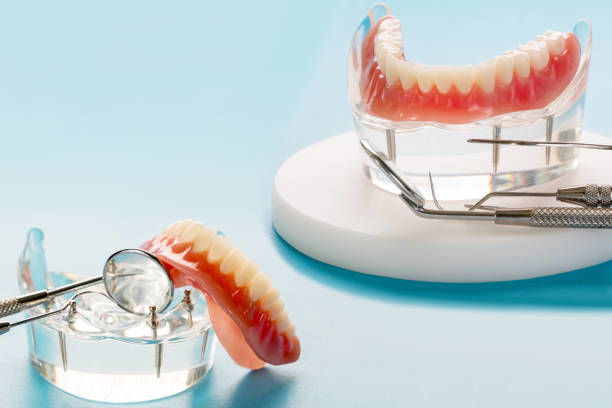 istock Teeth model showing an implant crown bridge model. 1314431902