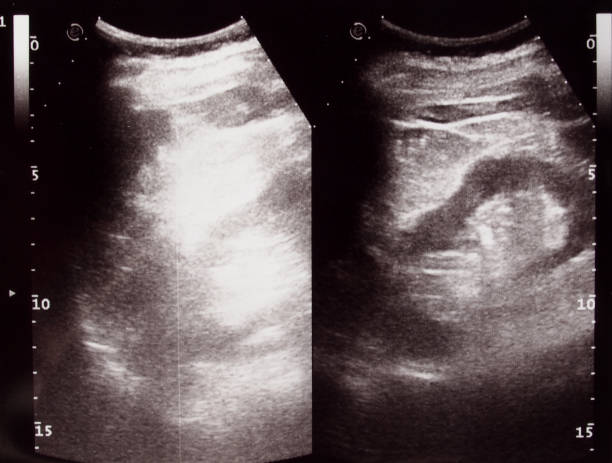 istock Diagnostic sonography of abdomen 1314467173