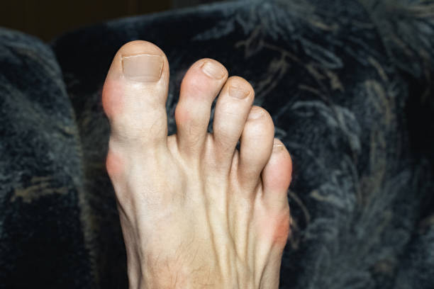 doigts gonflés et déformés avec des ostéophytes. inflammation des orteils due à la goutte ou à l’arthrite. articulations gonflées des pieds - big toe photos et images de collection