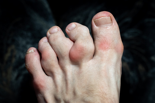swollen and deformed fingers with osteophytes. inflammation of the toes due to gout or arthritis. swollen joints of toes
