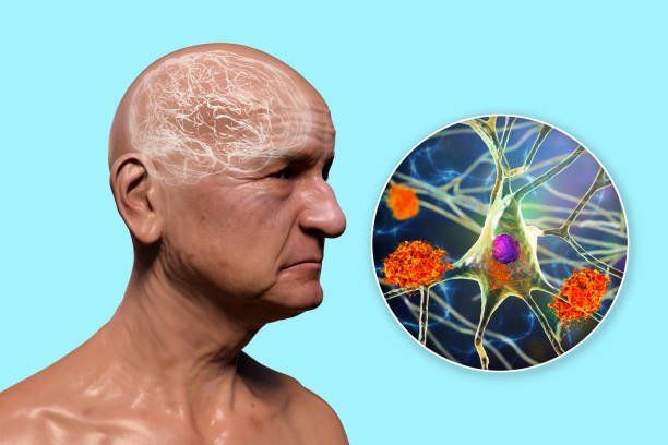 demens, konceptuell illustration - amyloid bildbanksfoton och bilder