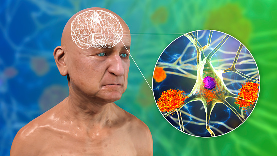 Dementia, conceptual 3D illustration showing an elderly person with progressive impairments of brain functions, amyloid plaques in brain, neurofibrillary tangles and distruction of neuronal networks