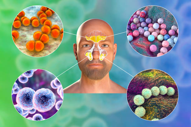 inflamación purulenta de senos paranasales frontales y maxilares en un hombre y visión de cerca de bacterias que causan sinusitis - mrsa bacterium streptococcus staphylococcus fotografías e imágenes de stock