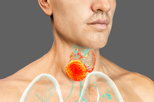 Thyroid cancer, 3D illustration showing tumor inside thyroid gland