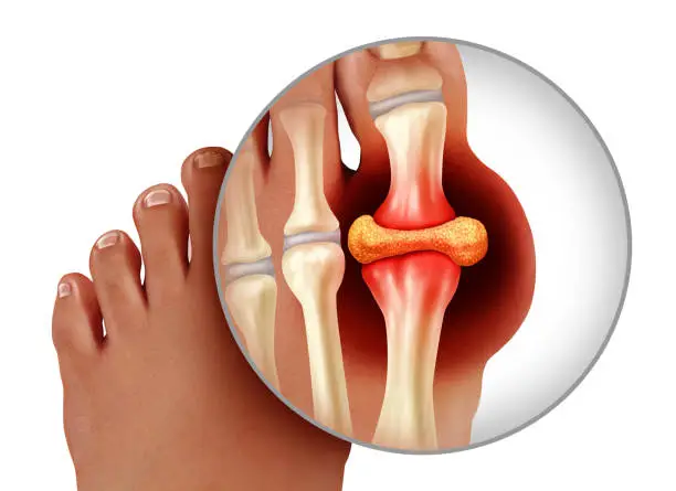 Foot gout and painful feet arthritis disease as toes close up with a human toe as a hyperuricemia symbol of treating and diagnosing chronic pain isolated on a white background as a 3D illustration style.