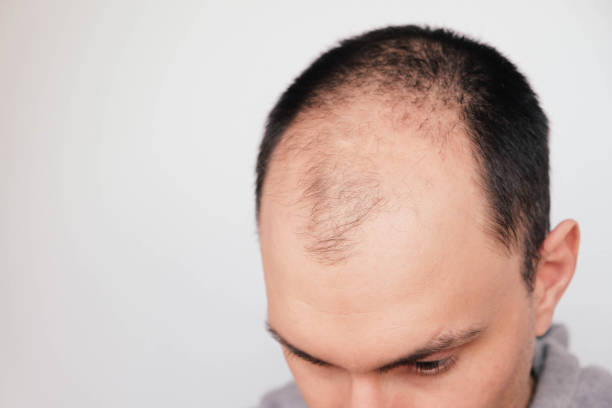 Male Pattern Hair Loss Problem Concept Young Man Losing Hair On Temples  Close Up Space For Text Baldness Alopecia In Males Stock Photo - Download  Image Now - iStock