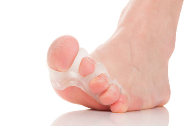 bunion, 할로 발거스. 구분 기호. - bunion bunions human foot podiatry 뉴스 사진 이미지