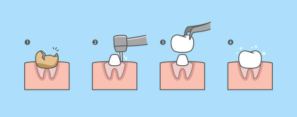 실제 뿌리 치아의 단계는 크라운 치아에 의해 복원됩니다. 파란색 배경의 그림 벡터 디자인입니다. 치과 치료 개념. - handpiece stock illustrations
