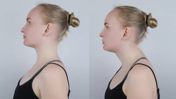 Before and after kyphosis. The woman suffers from a curvature of the spine in the upper section. The cervical vertebrae bulge out and form a hump. Curvature and incorrect posture treatment concept The woman suffers from a curvature of the spine in the upper section. The cervical vertebrae bulge out and form a hump. Curvature and incorrect posture treatment concept. Before and after kyphosis. kyphosis stock pictures, royalty-free photos & images