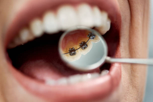 close-up da mulher que faz check-up de aparelhos linguis por ortodontista no consultório do dentista. - dental hygiene prosthetic equipment dentist office dental equipment - fotografias e filmes do acervo