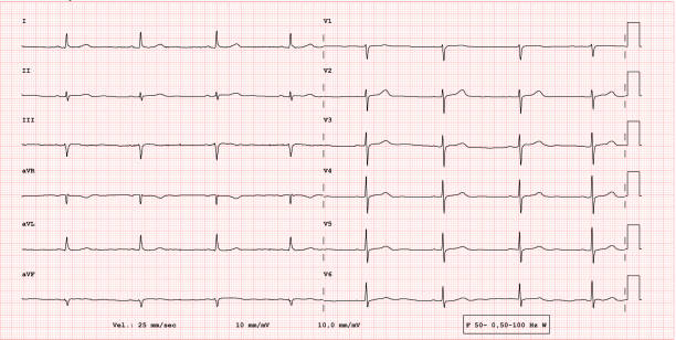 illustrations, cliparts, dessins animés et icônes de exemple d’ecg d’un rythme bradycardia 12-lead - fréquence cardiaque