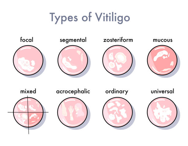 Types of vitiligo infographic icons Options for the spread and manifestation of the skin disease.Pigmentation problem.Patchy loss of derma color. Vector in flat style. Psoriasis. Medical banner vitiligo stock illustrations