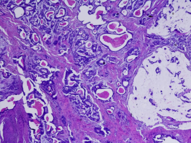 Gastric Adenocarcinoma Microscopic photo of a professionally prepared slide demonstrating gastric adenocarcinoma stomach cancer stock pictures, royalty-free photos & images