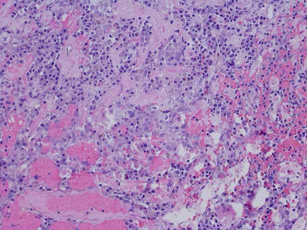 istock Scherosing pneumocytoma in the lung with hemorrhage 1315005284