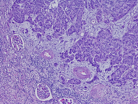 Invasive urothelial carcinoma nephroureterectomy in the kidney with vascular invasion