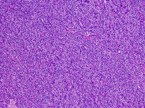 Metastatic leydig cell tumor in the lymph node