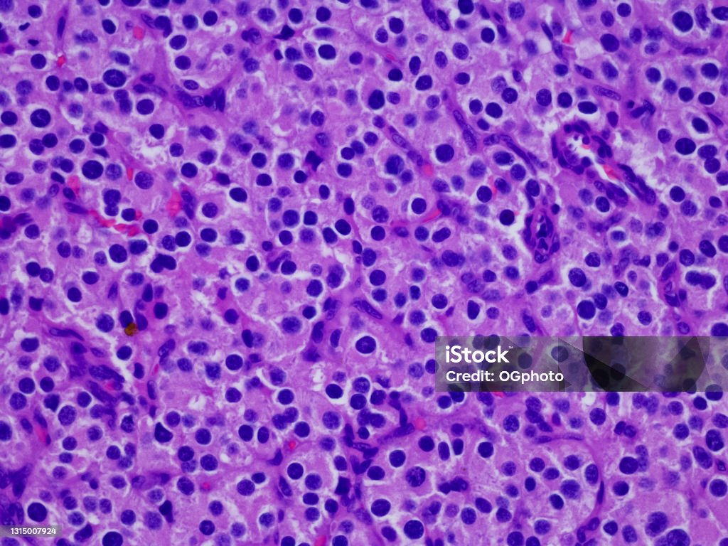 Metastatic leydig cell tumor in the lymph node Lymph Node Stock Photo