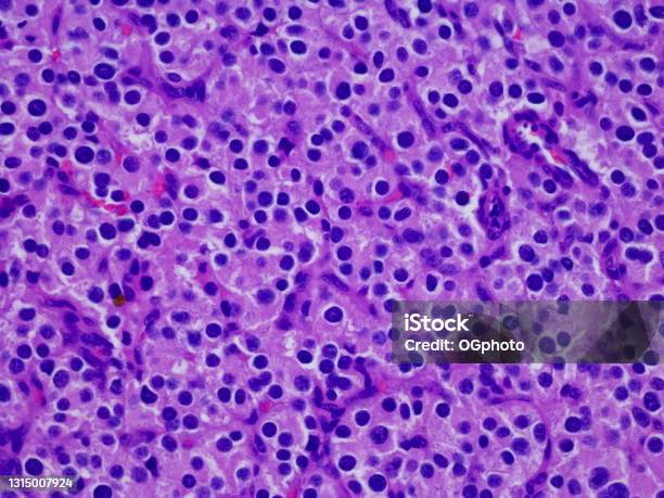 Metastatic Leydig Cell Tumor In The Lymph Node Stock Photo - Download Image Now - Lymph Node, Photography, Tumor