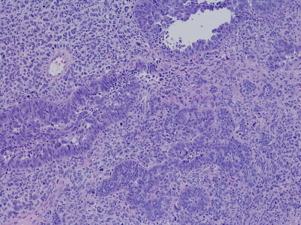 istock Fallopian tube serous carcinoma primary 1315011532