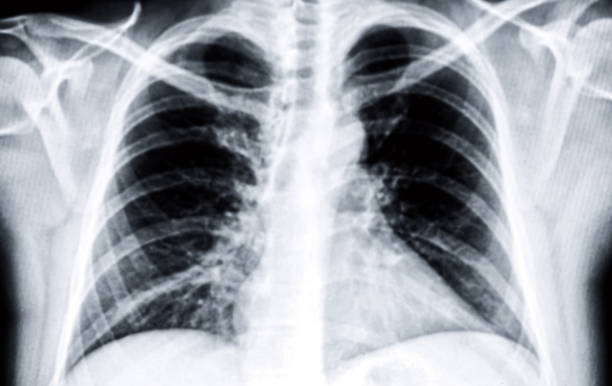 detalhe de um raio-x de pulmões masculinos. preto e branco - radiogram photographic image - fotografias e filmes do acervo