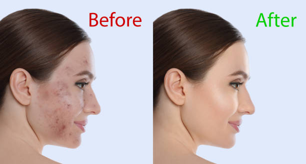 istock Young woman before and after cosmetic procedure on light background 1315162175