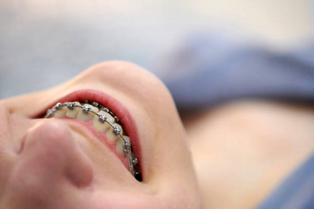 Young man showing crooked growing teeth. The man needs to go to the dentist to install braces.