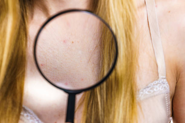 istock Woman with skin problem acne on neckline 1315224604