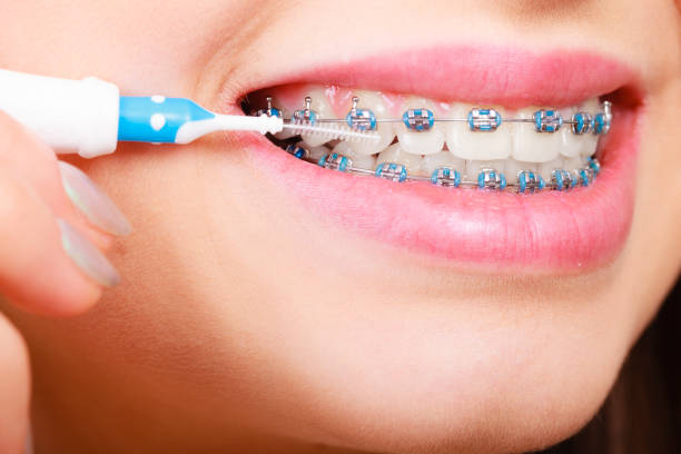 istock Woman brushing teeth with braces using brush 1315338638