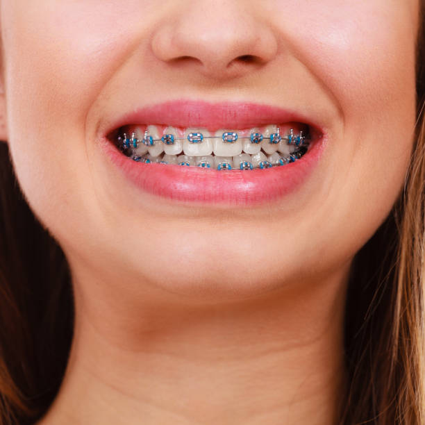 istock Woman showing her teeth with braces 1315339519