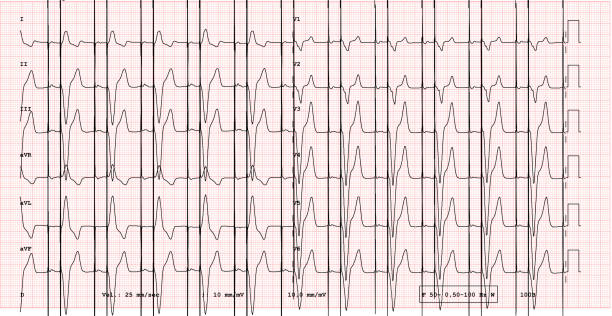 ECG example of a pacemaker, rhythm with pacing peak vector art illustration